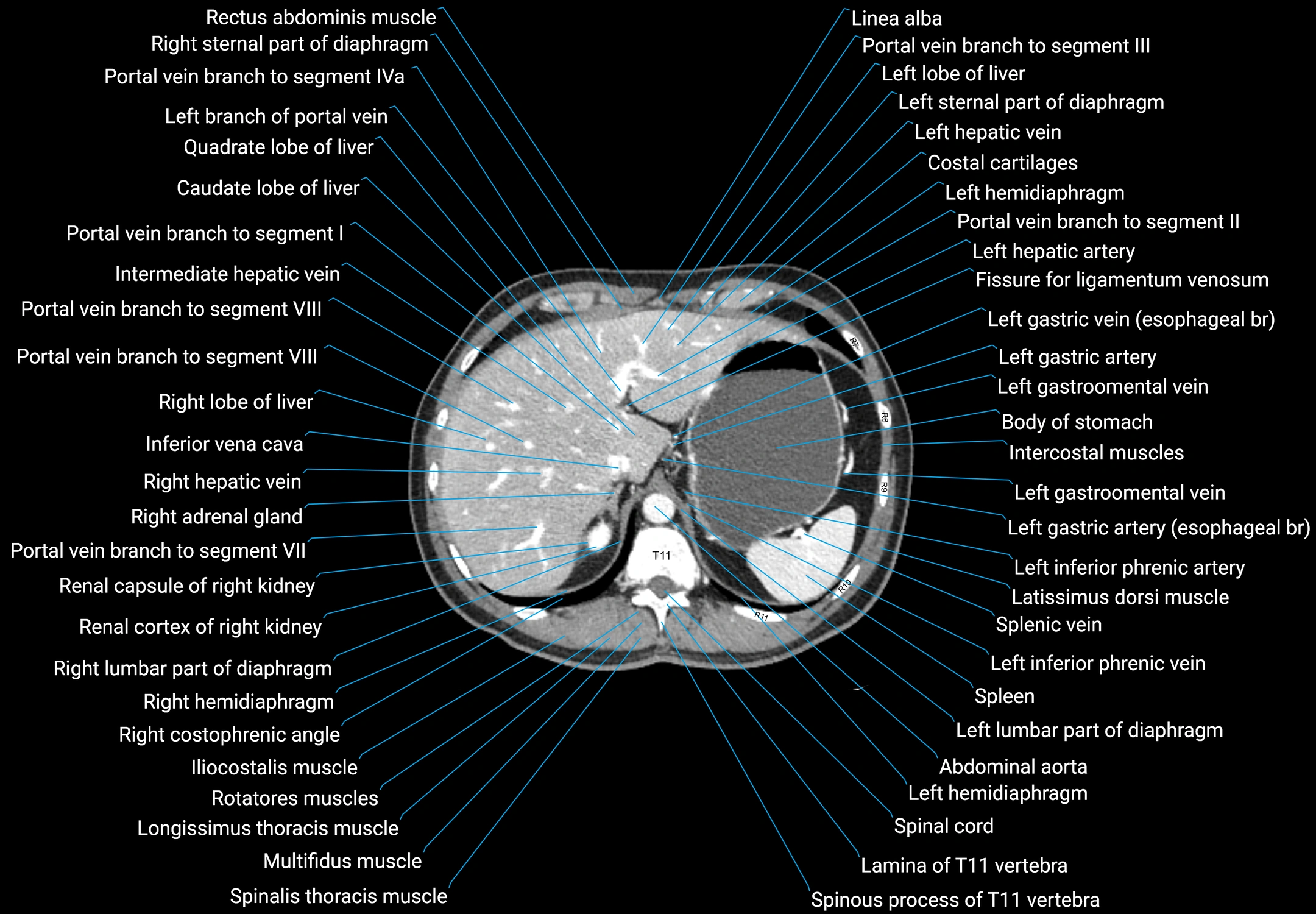 CT male pelvis axial cross sectional anatomy labelled radiology image -00031.webp